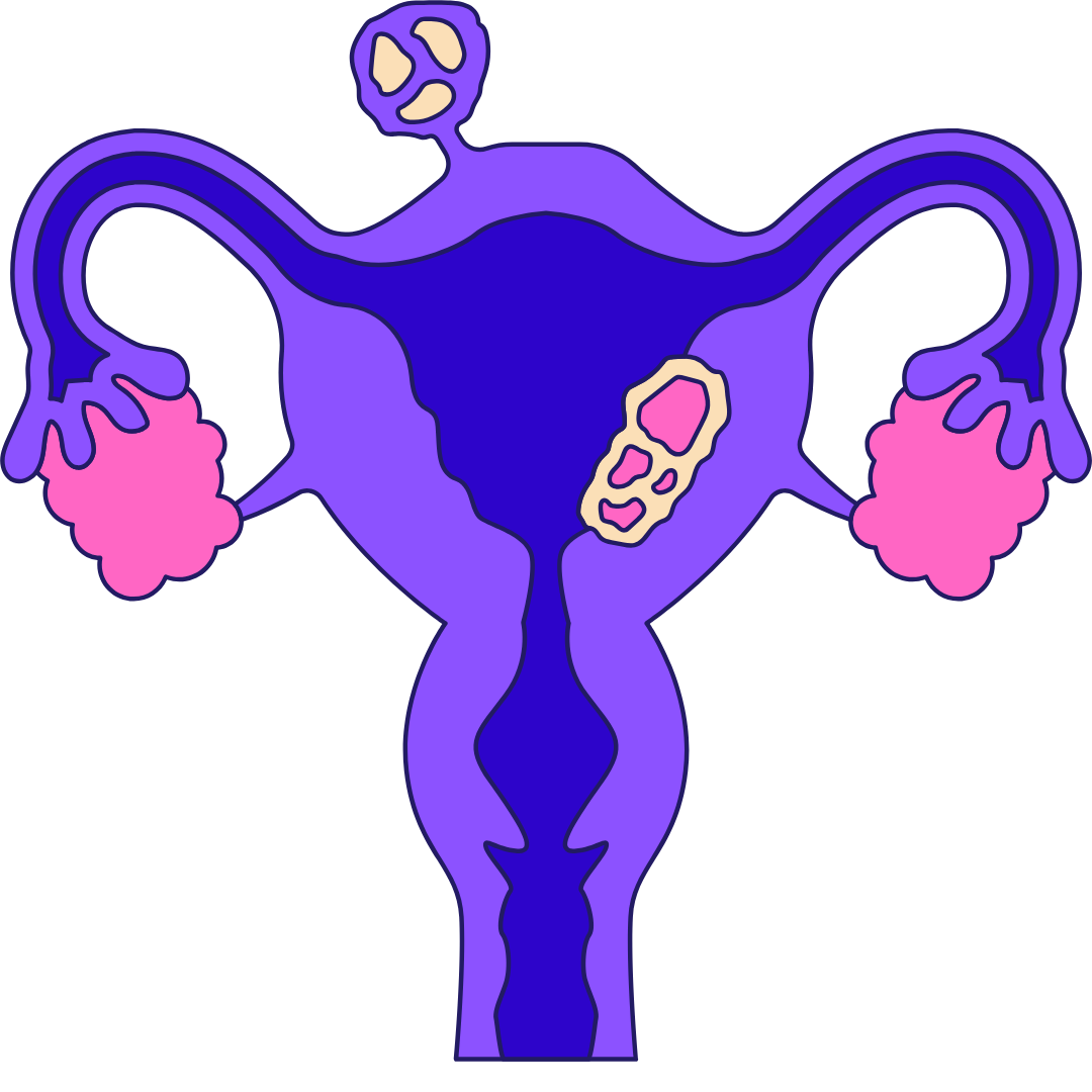 women_Uterine_Fibroid